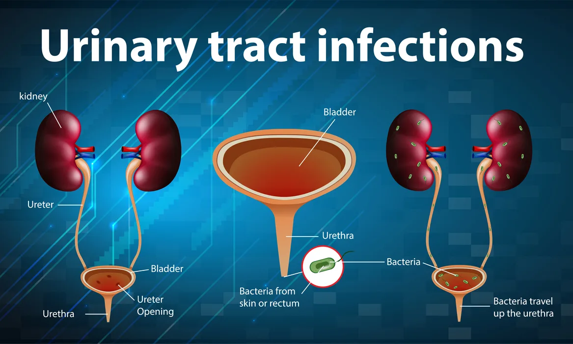urinary tract infections