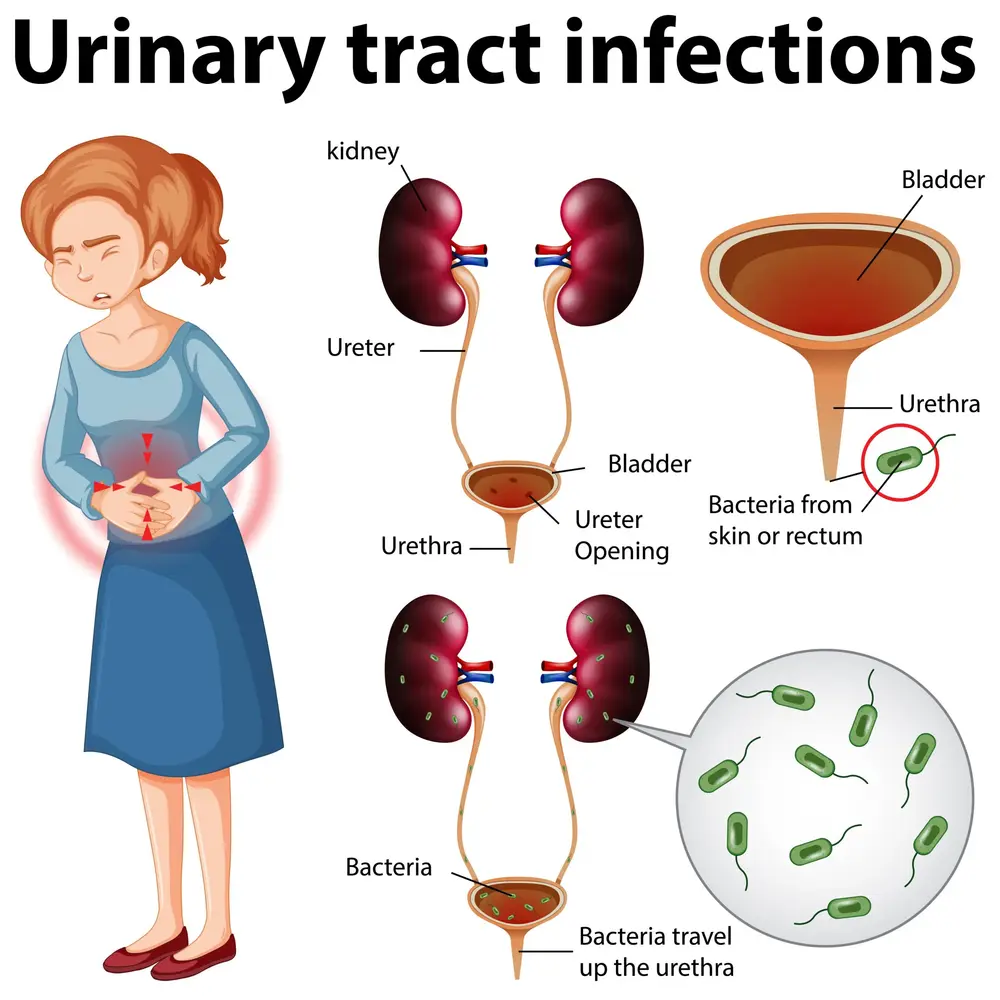 Urinary Tract Infection - UTI