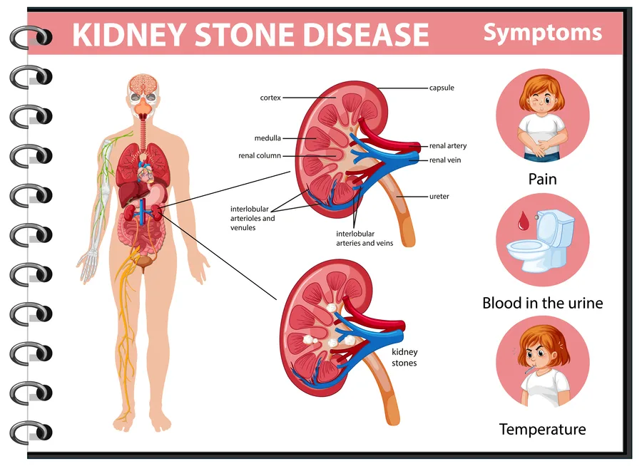 स्टोन पथरी5